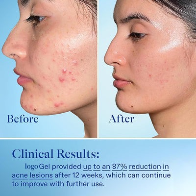 Freckle & Acne Removal Treatment Gel